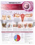 Infertility Anatomical Chart, 2nd Edition